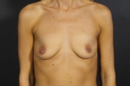 Before image 1 Case #83266 - Breast Augmentation with Shaped SIlicone Implants