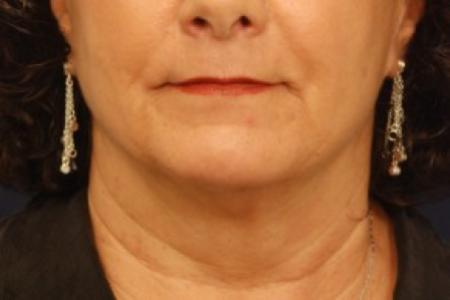 Before image 1 Case #87736 - Lower Facial Rejuvenation