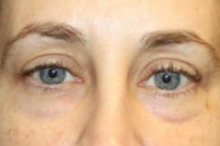 Before image 1 Case #84531 - Blepharoplasty - Lower Lids Only - 41 year old female