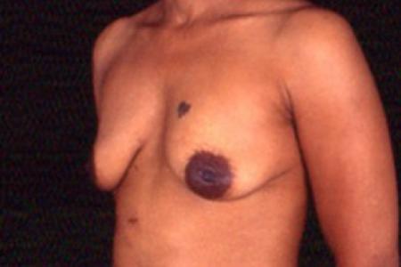 Before image 2 Case #81471 - Breast Augmentation/Lift