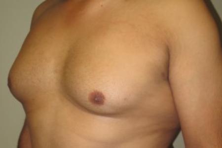 Before image 2 Case #82406 - 37 Male Gynecomastia