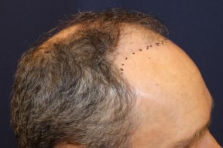 Before Case #87381 - Hair Transplantation San Diego