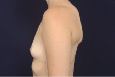 Before image 3 Case #87526 - Breast Augmentation