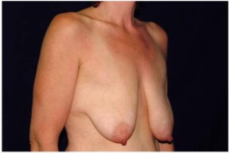 Before image 2 Case #82056 - Breast Lift