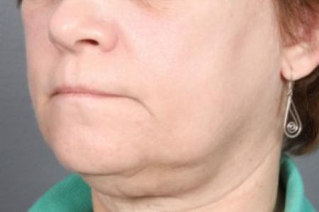 Before image 2 Case #83581 - Neck Liposuction
