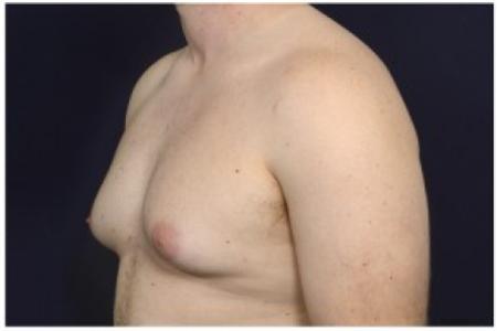 Before image 2 Case #85611 - Gynecomastia