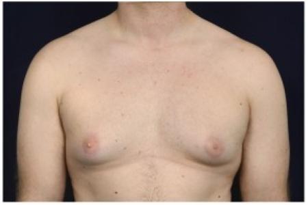 Before image 1 Case #85611 - Gynecomastia