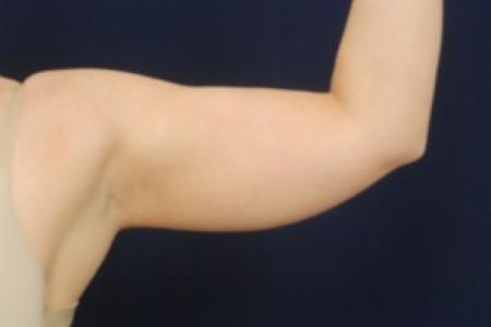 Before image 1 Case #87751 - Upper Arm Liposuction