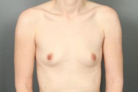 Before image 1 Case #83211 - Breast Augmentation with Round Silicone Implants