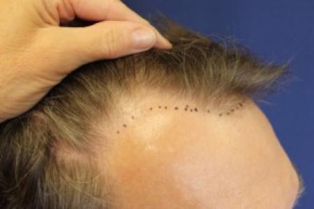 Before Case #87391 - Hair Transplantation San Diego