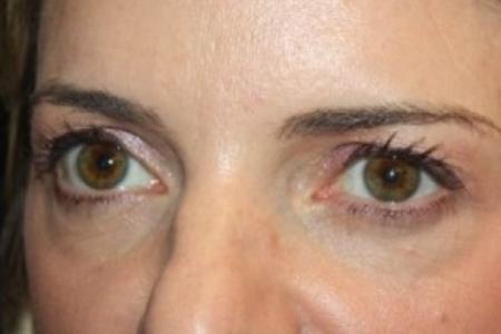 Before image 2 Case #84206 - Upper Lid Blepharoplasty - 42 year old female