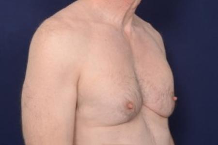 Before image 2 Case #87516 - Gynecomastia