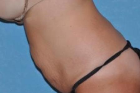 Before image 2 Case #83421 - Abdominoplasty