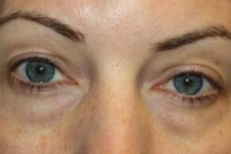 Before image 1 Case #85846 - Blepharoplasty - Upper and Lower Lids - 42 year old female