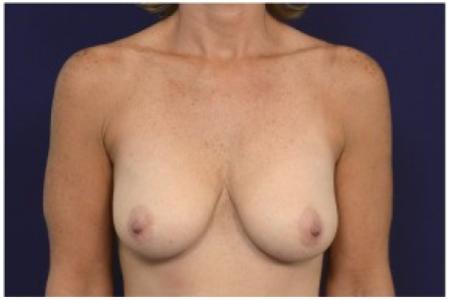 Before image 1 Case #86306 - 48 year old woman treated with a Breast Lift