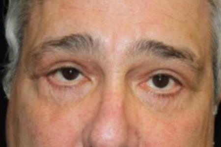 Before image 1 Case #83461 - Blepharoplasty - 61 year old male.