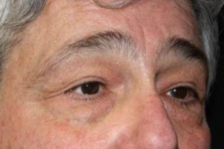 Before image 2 Case #83461 - Blepharoplasty - 61 year old male.