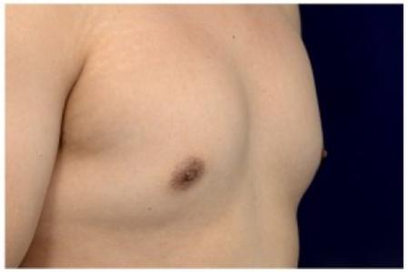 Before image 4 Case #82176 - Gynecomastia
