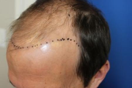 Before Case #87396 - Hair Transplantation San Diego