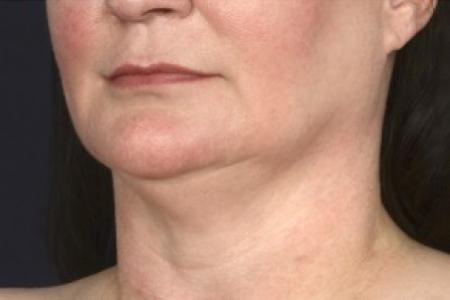 Before image 2 Case #87041 - Lower Facial Rejuvenation 