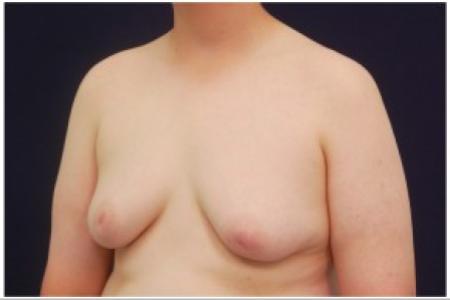 Before image 2 Case #82071 - Gynecomastia