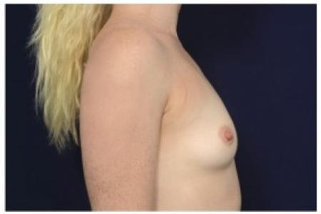Before image 3 Case #87486 - Breast Augmentation