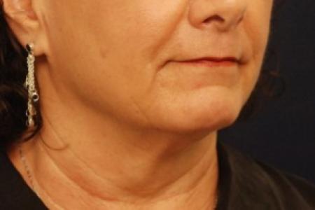 Before image 2 Case #87736 - Lower Facial Rejuvenation
