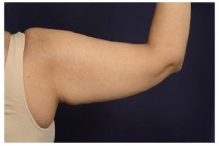 Before image 2 Case #87061 - Upper Arm Lift