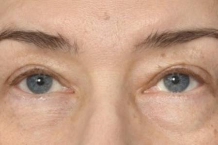 Before image 1 Case #87451 - Eye Area Rejuvenation
