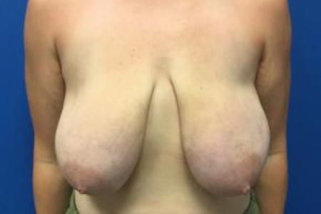 Before image 1 Case #88431 - Breast lift on a 32 year old female