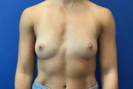Before image 1 Case #88306 - Breast Augmentation on a 27 year old female