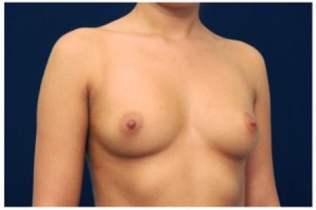 Before image 2 Case #87691 - Breast Augmentation