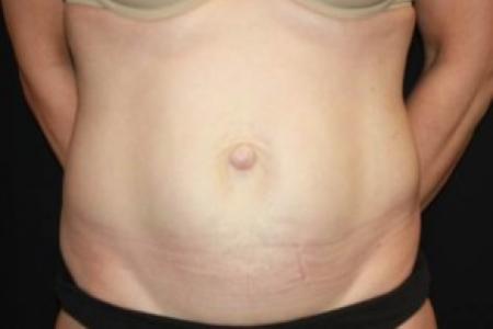 Before image 1 Case #85051 - Abdominoplasty - 47 year old female
