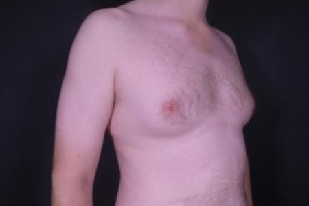Before image 2 Case #85311 - Liposuction Gynecomastia