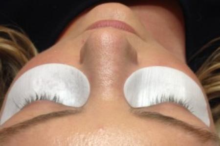Before Case #86381 - 35 year old woman treated with eyelash enhancement