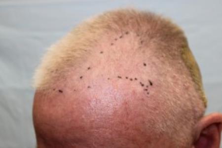 Before Case #87386 - Hair Transplantation San Diego