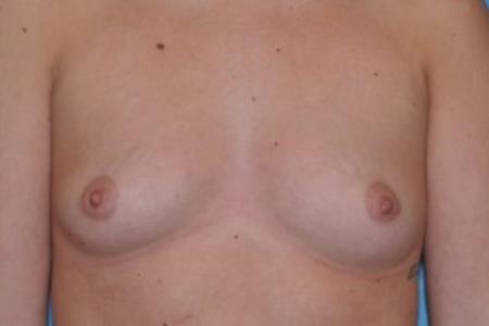 Before image 1 Case #83961 - Breast Augmentation Before and After