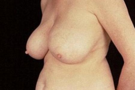 Before image 2 Case #81486 - Breast Reduction