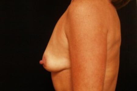 Before image 3 Case #81701 - Breast Augmentation