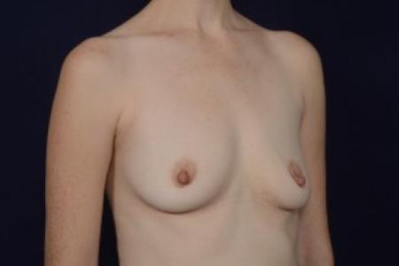 Before image 2 Case #87596 - Breast Augmentation