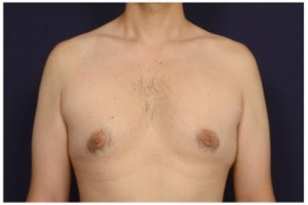Before image 1 Case #84501 - Gynecomastia