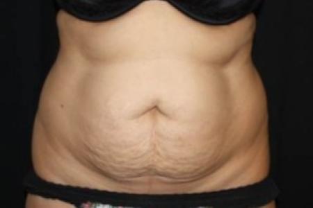 Before image 1 Case #84916 - Abdominoplasty - 44 year old female
