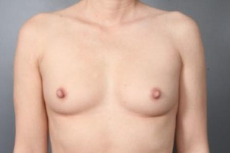 Before image 1 Case #83431 - Breast Augmentation with Submuscular Saline Implants