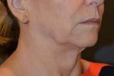 Before image 2 Case #85701 - Traditional Facelift 