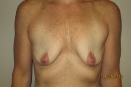 Before image 1 Case #82416 - 40 Female Breast Lift