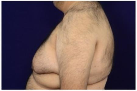Before image 3 Case #86921 - Gynecomastia