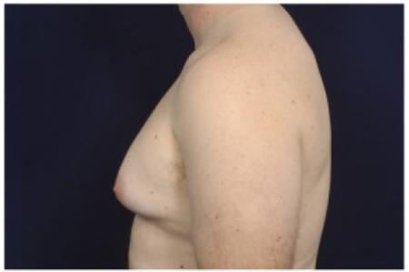 Before image 3 Case #85611 - Gynecomastia