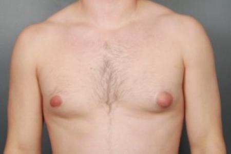 Before image 1 Case #83711 - Gynecomastia