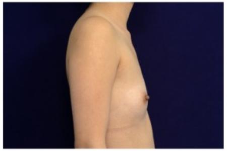 Before image 3 Case #86911 - Breast Augmentation