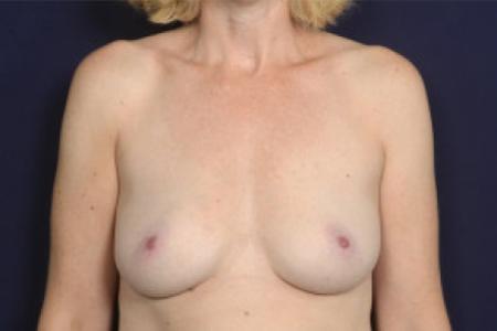 Before image 1 Case #102571 - Breast Augmentation